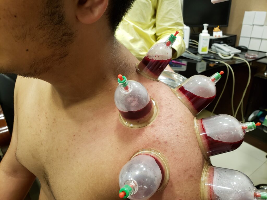 Chinese Cupping Therapy (Hijama) See Do Make